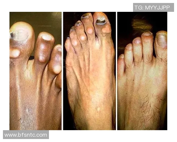 足球明星因长期训练导致脚趾变形的真实记录与背后故事揭秘 足球明星因长期训练导致脚趾变形的真实记录与背后故事揭秘